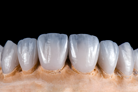 Ultra - Translucent Multilayered Zirconia